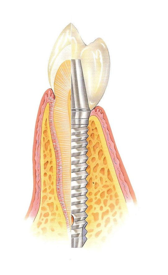 Zubný implantát Zubný implantát