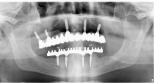 Opg snímok po zavedení zubných implantátov