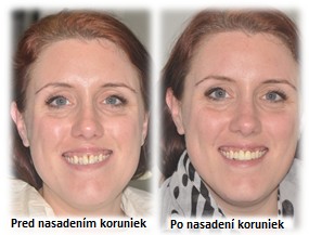 Pred a po nasadení koruniek