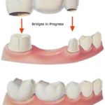 bridges in process and bridges in place