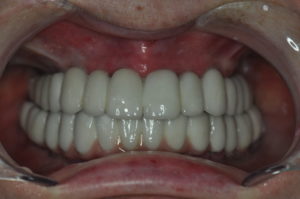 dental bridges
