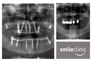 x-ray pred a po ošetrení